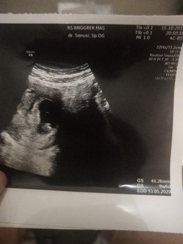 usia janin brp terdengar detak jantung