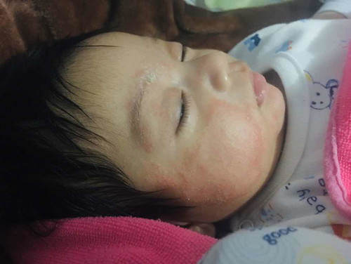 ลูกเป็นผื่นแดงแข็งทำไงดีคะ