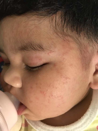 ผื่นเด็ก