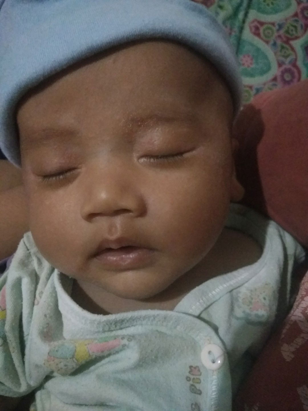 Kulit Bayi Kasar Kyk Ngelupas