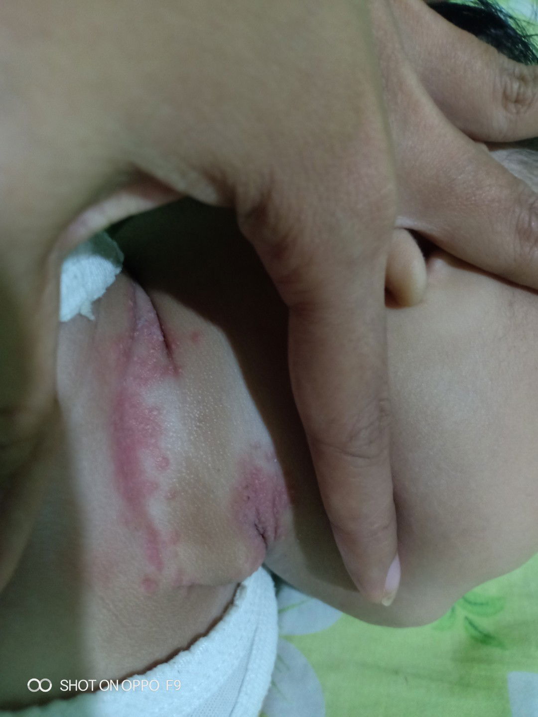 bintik merah d leher