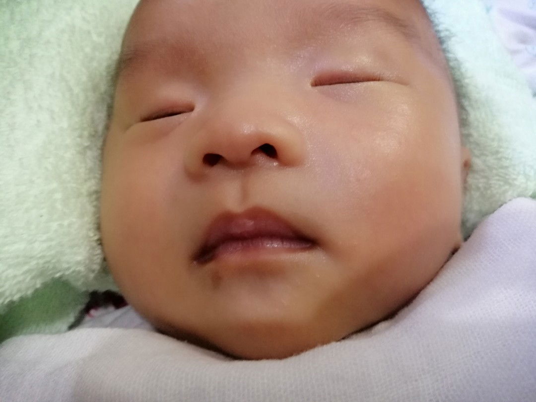 Bớt chàm làm sao xóa được???