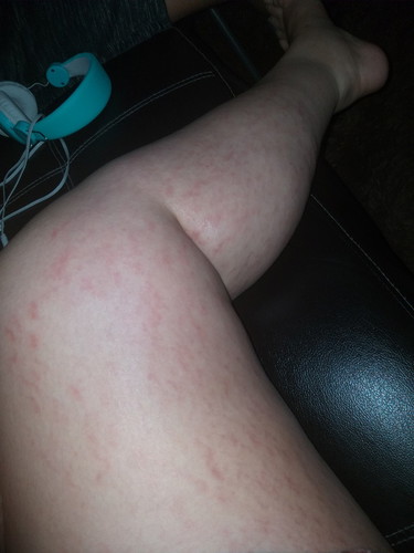 stretch marks
