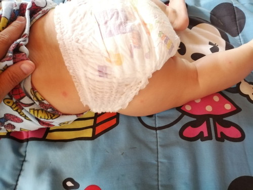 วิธีป้องกันยุงกัด