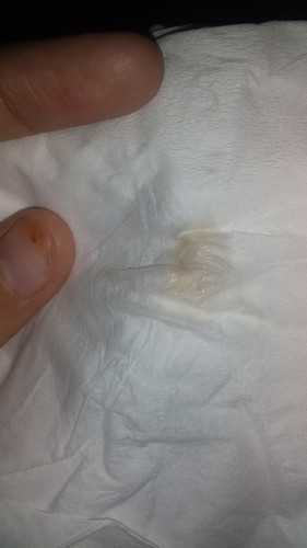 sakit perut dan keputihan