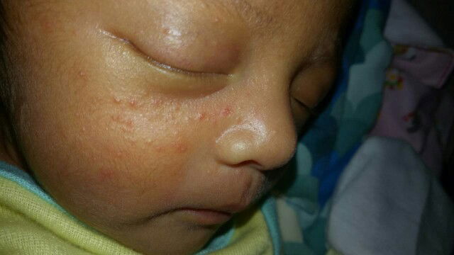 jerawat di muka baby
