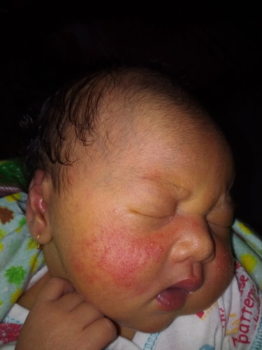 Beruntusan bayi