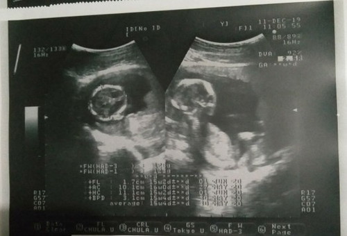 อวดภาพอัลตราซาวนด์ตอน15weekกันหน่อยจ้าาา
