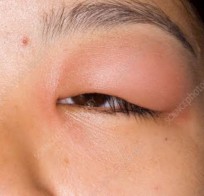 Bug Bite? (on Eyelids)