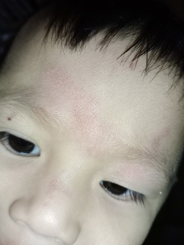 ผดผื่น