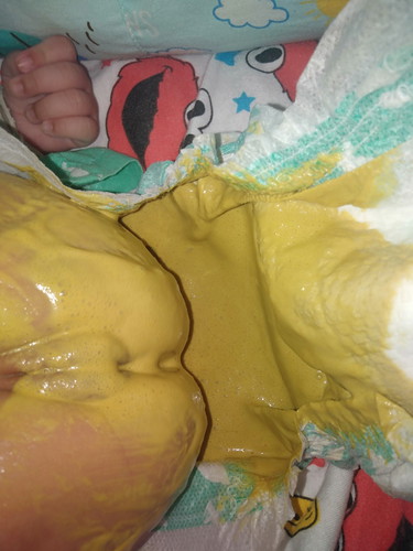 เปลี่ยนนมแล้วอึเป็นแบบนี้