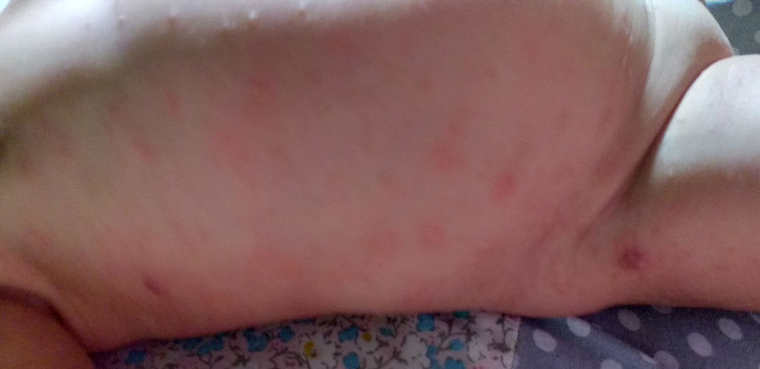 bintik merah berair dan bernanah