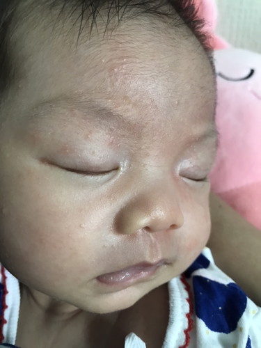 ลูกเป็นผดเยอะขึ้นบนใบหน้า อันตรายไหมคะ
