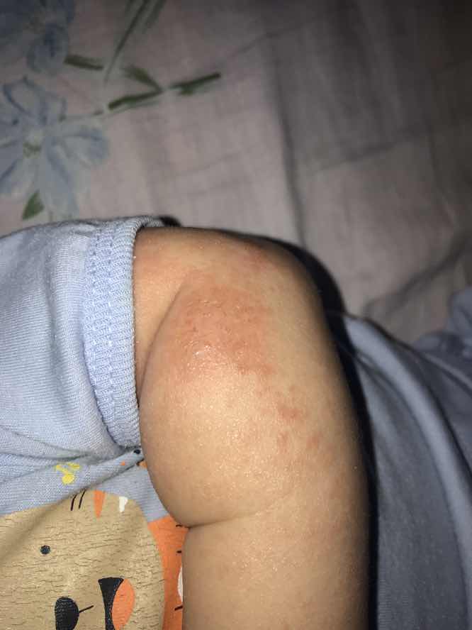 Kulit baby 4 months melecet