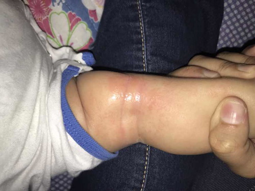 Eczema baby