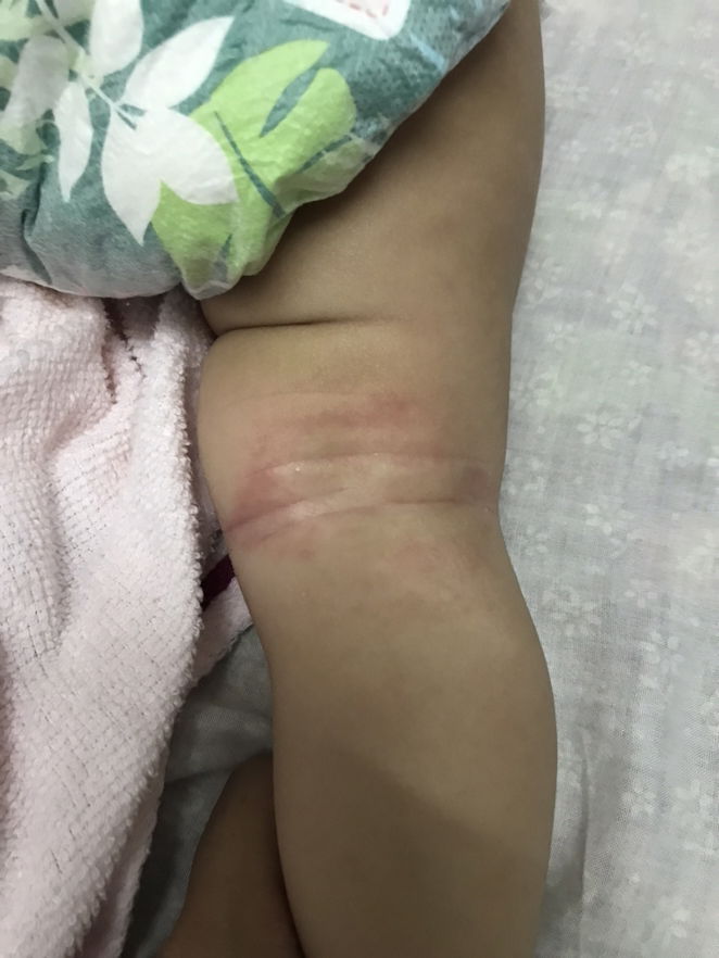 The Eczema Journey (ongoing)