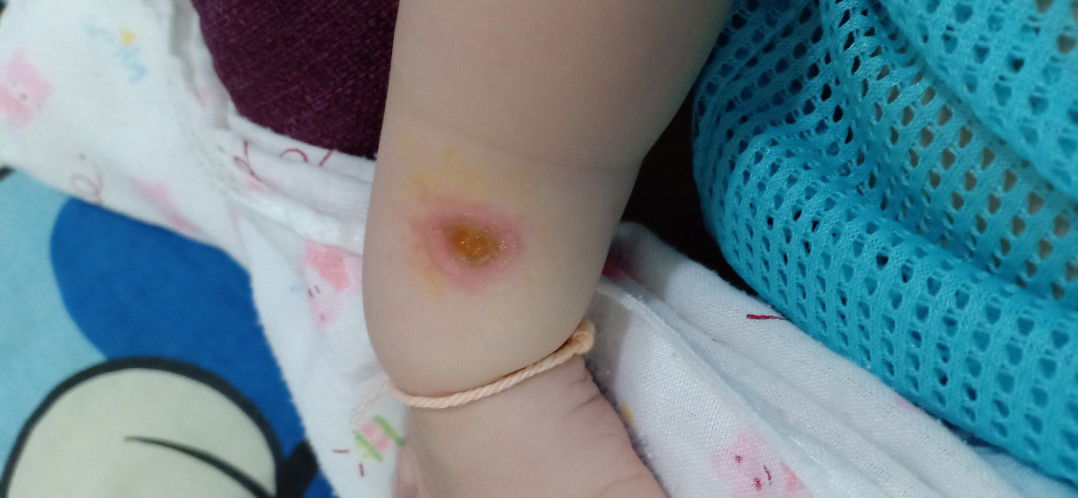 น้องเป็นแผลแบบนี้ใช้ยาอะไรทาได้บ้างคะ