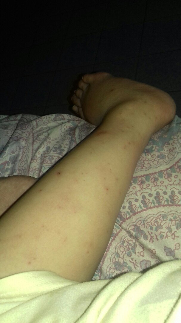 gatal2 di kaki