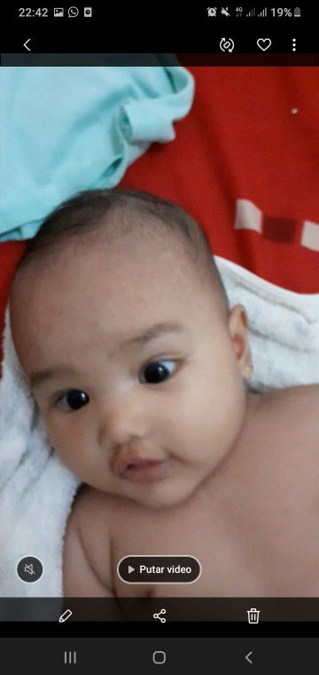 Biang keringat atau campak?