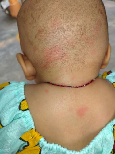 ผื่นแดง