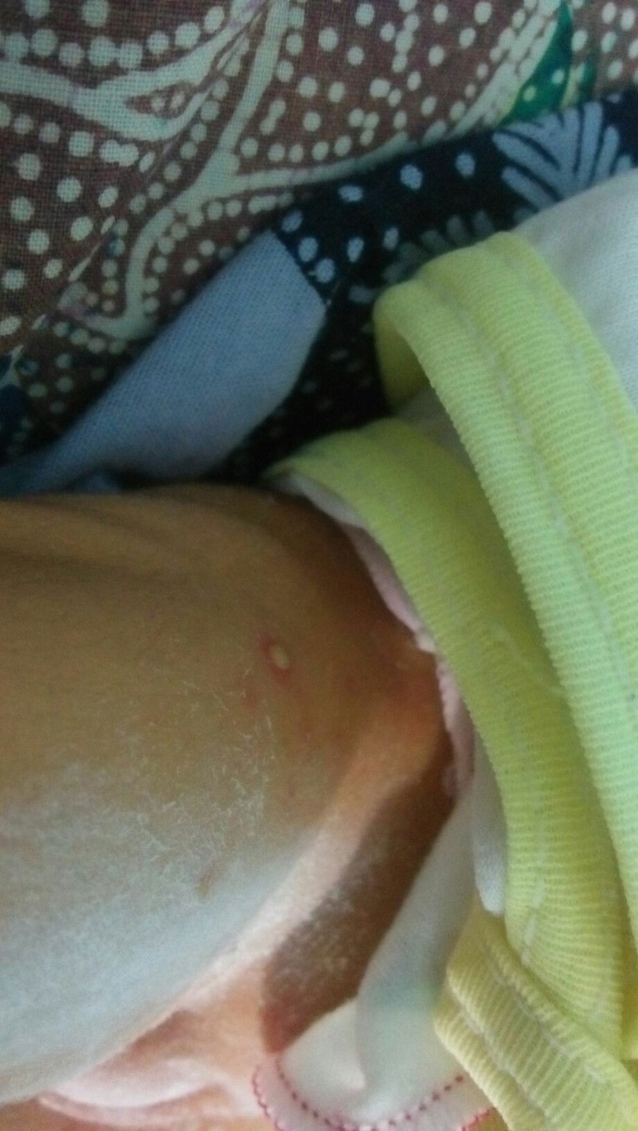 bintik seperti cacar