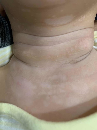 Scar removal advice needed