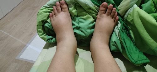 แม่ๆเท้าบวมตอน35w4d. แบบนี้กันไหมคะ