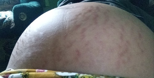 stretch marks