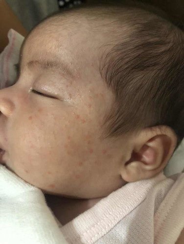Baby rash, baby acne or heat rash?