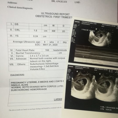 Subchorionic Hemorrhage