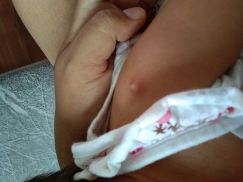 ปลูกฝีที่แขนแล้วนูนสุก