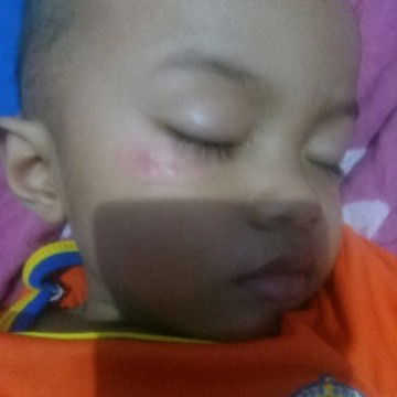 merah n gatal d bwh mata