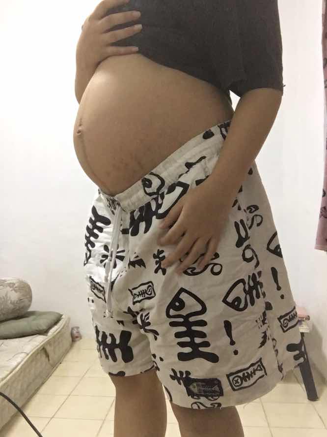 ท้องแตกลาย