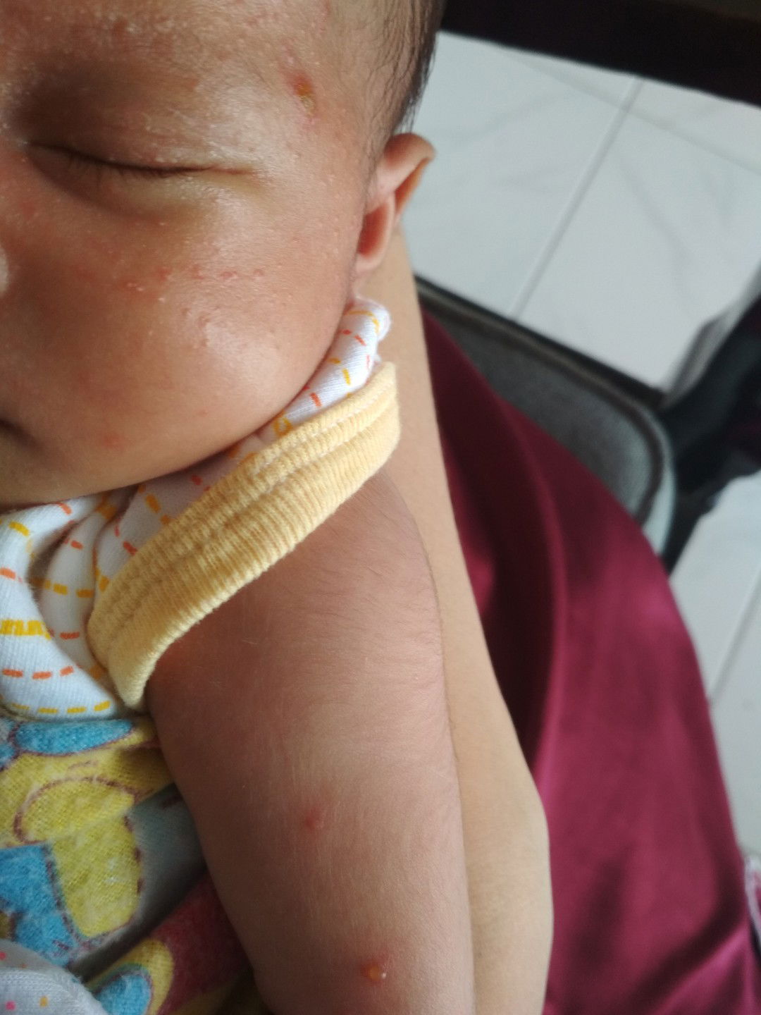 muncul ruam serta lentingan berisi air