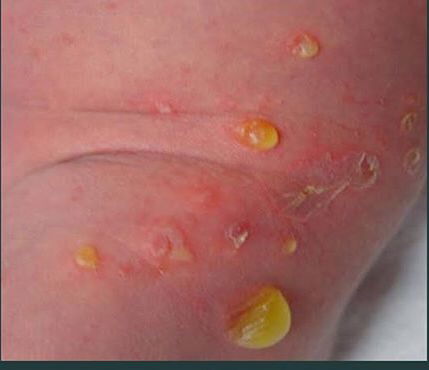 Imperigo bolusa /  lepuhan cairan kuning