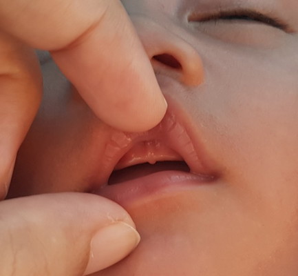 lip tie