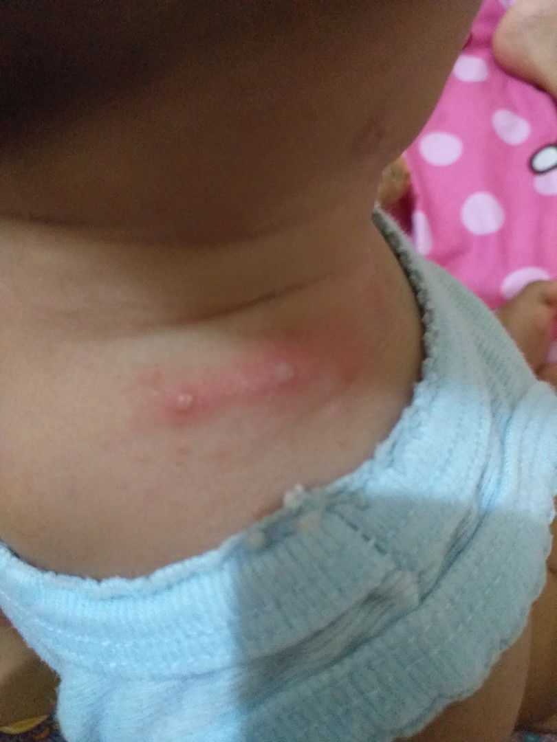 Bintik merah pada bayi