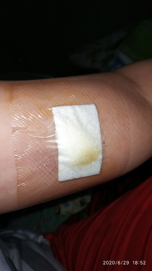 Berapa lama baru bisa berhubungan badan setelah pemasangan KB Implan