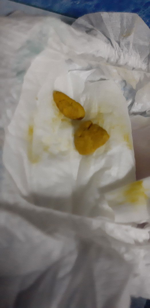 Bayi 2bulan sembelit