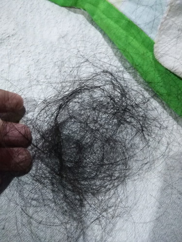 Loss Hair