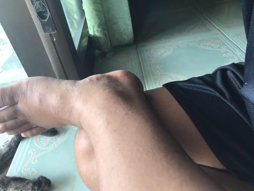 แม่ๆคนไหนมีผื่นชึ้นตอนตั้งครรภ์บ้างค่ะ