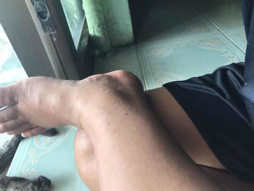 แม่ๆคนไหนมีผื่นชึ้นตอนตั้งครรภ์บ้างค่ะ