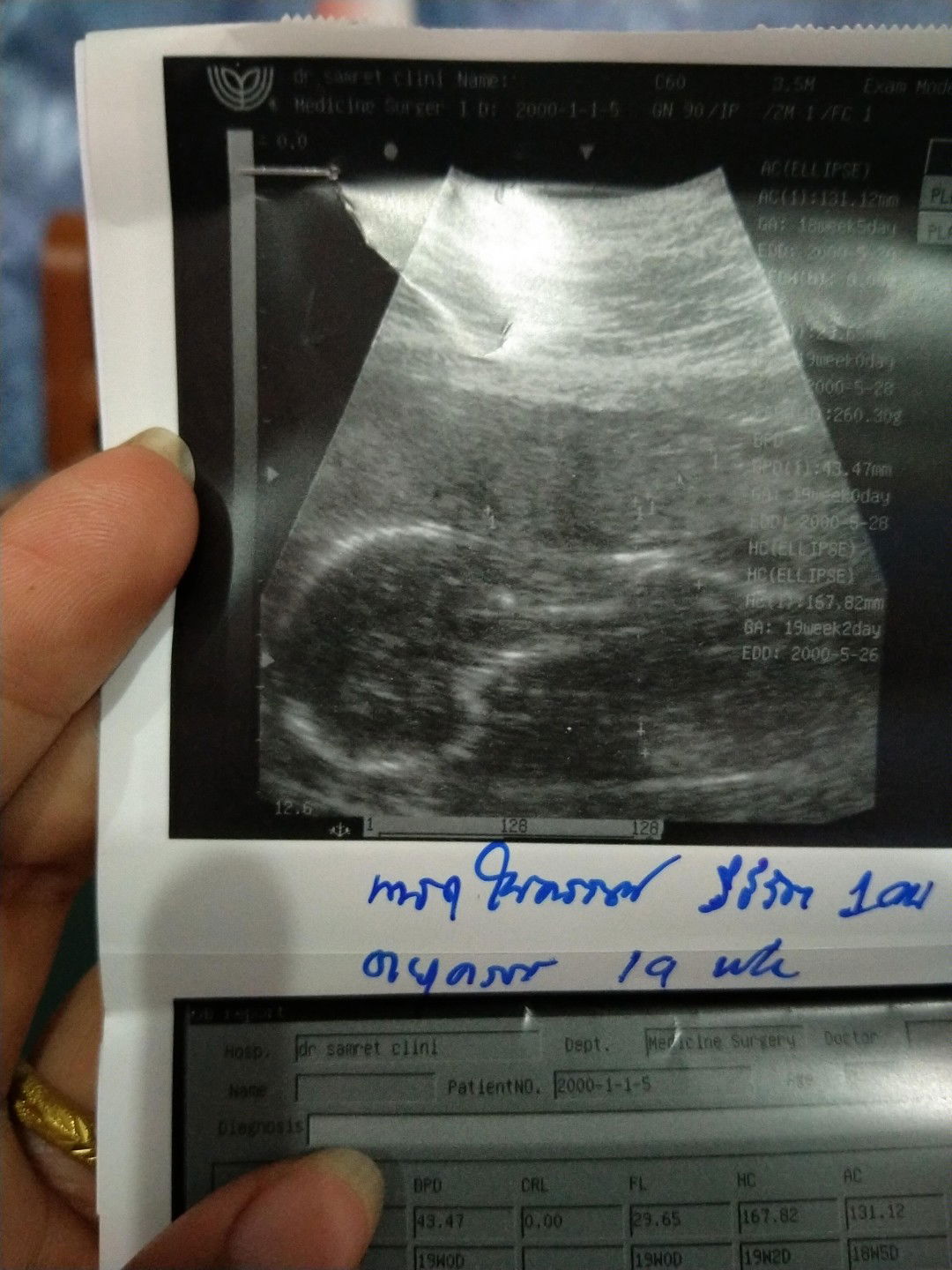 19weekแล้วน้องยังน้ำหนักแค่260กรัมเองค่ะ