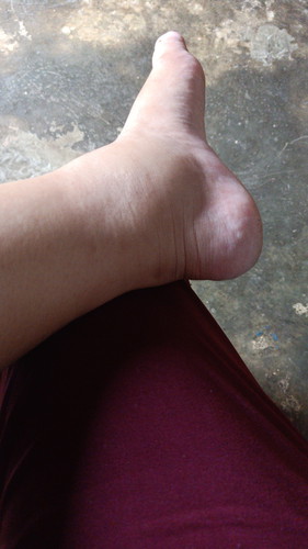 kaki bengkak