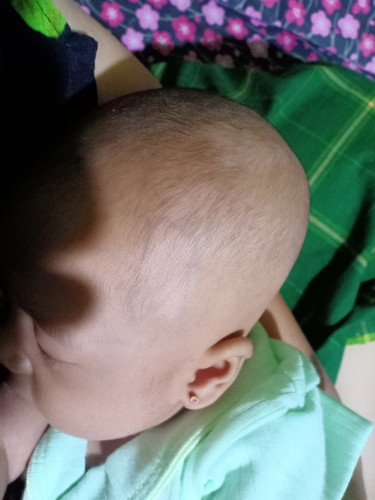 bercak putih dikulit kepala bayi