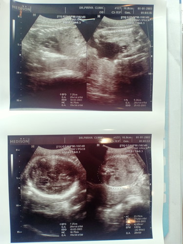 29 w 3 d
