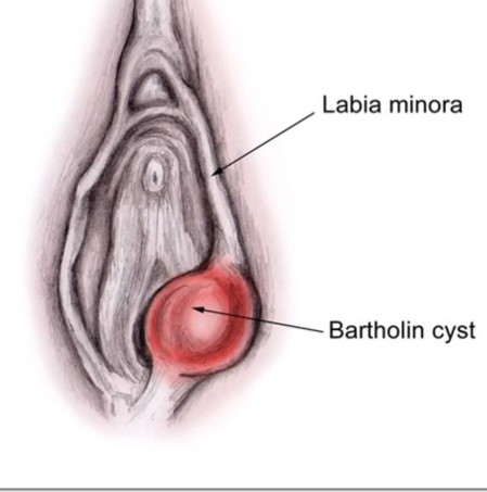 bartholin cyst