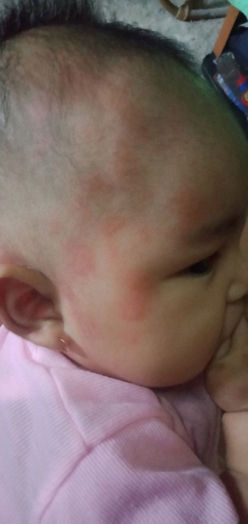 Merah merah pada kulit