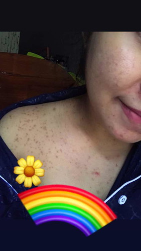 Bruntusan gawan bayi