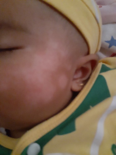 ruam susu